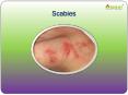 Scabies: Causes, Symptoms, Daignosis, Prevention and Treatment PowerPoint PPT Presentation