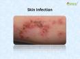 Skin Infection : Causes, Symptoms, Treatment, Prevention PowerPoint PPT Presentation