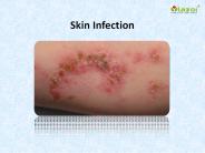 Skin Infection : Causes, Symptoms, Treatment, Prevention