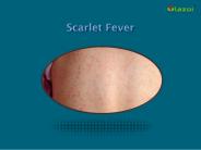 Scarlet Fever: Causes, Symptoms, Treatment and Prevention (1)