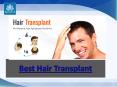 Best Hair Transplant PowerPoint PPT Presentation