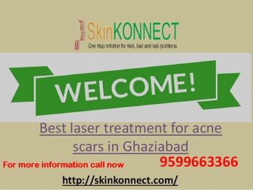 Best laser treatment for acne scars in Ghaziabad 9599663366.