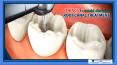 Things to Avoid During a Root Canal Treatment PowerPoint PPT Presentation