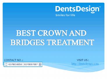 Best Crown and Bridges treatment in Pune| Dents Design