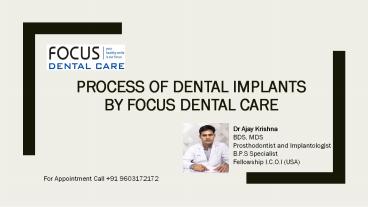Process of Dental Implants | Dental Implants in India