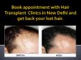 Best Hair Transplant Clinics in New Delhi | Hair-transplant