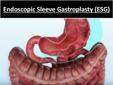 Endoscopic Sleeve Gastroplasty (ESG)