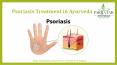 Best Psoriasis treatment ayurveda  in nagpur PowerPoint PPT Presentation