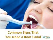 Common signs that you need root canal