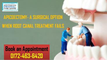 Apicoectomy- A Surgical Option When Root Canal Treatment Fails