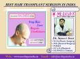 Best Hair Transplant Surgeon in India PowerPoint PPT Presentation