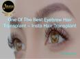 One Of The Best Eyebrow Hair Transplant Insta hair transplant PowerPoint PPT Presentation