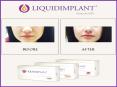 High Quality Hyaluronic Acid Filler Gel PowerPoint PPT Presentation