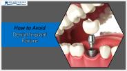 How to Avoid Dental Implant Failure