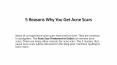 5 Reasons Why You Get Acne Scars PowerPoint PPT Presentation