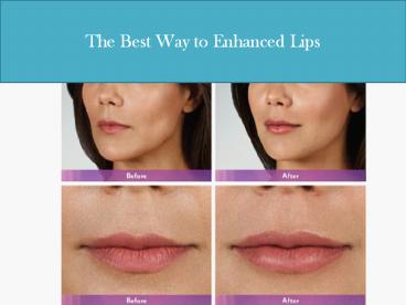 The Best Way to Enhanced Lips