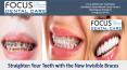 Straighten Your Teeth with the New Invisible Braces by Focus Dental Care PowerPoint PPT Presentation