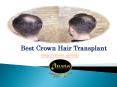 Best crown hair transplant PowerPoint PPT Presentation