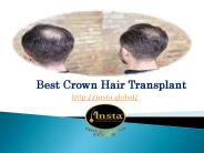 Best crown hair transplant