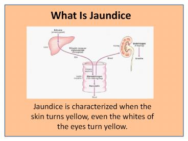 Jaundinil Helps in the Treatment of Jaundice