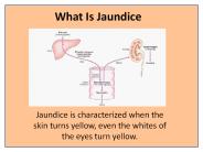 Jaundinil Helps in the Treatment of Jaundice