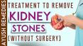 Kidney Stone Treatment without Surgery to Remove Stones in Home PowerPoint PPT Presentation