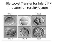 Blastocyst Transfer for Infertility Treatment | Fertility Centre