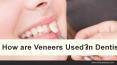 How are Veneers Used in Dentistry PowerPoint PPT Presentation