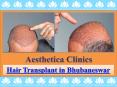 Hair Transplant in Bhubaneswar PowerPoint PPT Presentation