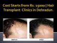 Hair Transplant Clinics, Doctors, Cost in Chandigarh | Hair-Transplant-India