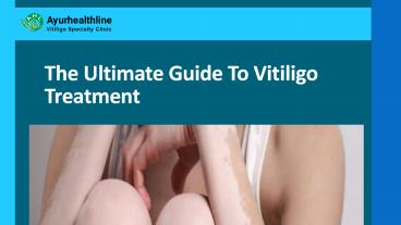 The Ultimate Guide To Vitiligo Treatment