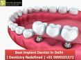 Best Implant Dentist in Delhi | Dentistry Redefined | +91 9999201572 PowerPoint PPT Presentation