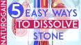 5 Easy Ways to Dissolve Kidney Stone, Improve Kidney Health PowerPoint PPT Presentation