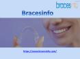 Invisalign Braces Reviews PowerPoint PPT Presentation