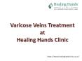Varicose Veins Treatment at Healing Hands Clinic PowerPoint PPT Presentation