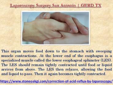Laparoscopy Surgery San Antonio | GERD TX