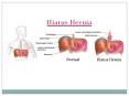 Hiatus Hernia PowerPoint PPT Presentation