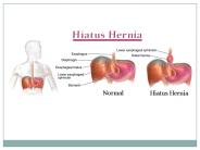 Hiatus Hernia