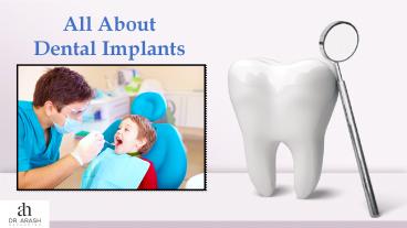 Dental implants