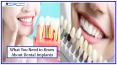 What you Need to Know About Dental Implants PowerPoint PPT Presentation