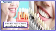 What you Need to Know About Dental Implants