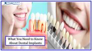 What you Need to Know About Dental Implants PowerPoint PPT Presentation