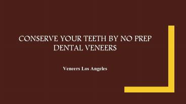 veneers Los Angeles