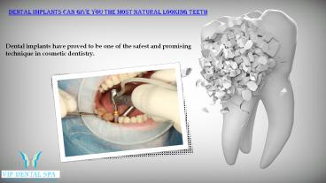 Dental implants Los Angeles