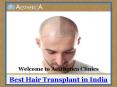 Best Hair Transplant in India PowerPoint PPT Presentation