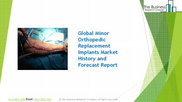 Minor Orthopedic Implants Replacement Market 2021 Forecasts