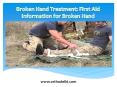 Broken Hand Treatment: First Aid Information for Broken Hand PowerPoint PPT Presentation