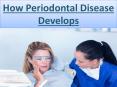 How Periodontal Disease Develops PowerPoint PPT Presentation