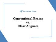 SR DENTAL – Conventional Braces vs Clear Aligners