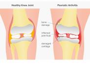 Psoriatic Arthritis in Victoria